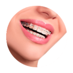 sourire avec des bagues dentaires transparentes