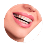 sourire avec des bagues dentaires transparentes