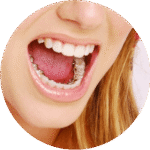 sourire avec des bagues à l intérieur de la bouche, invisible en extérieur