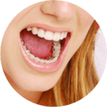 sourire avec des bagues à l intérieur de la bouche, invisible en extérieur