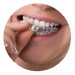 traitement orthodontique avec une gouttière invisible