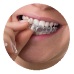 traitement orthodontique avec une gouttière invisible