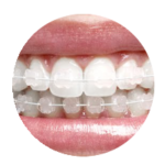 traitement orthodontique avec des bagues transparentes pour adultes et adolescents