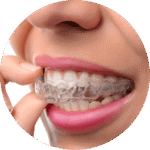 traitement orthodontique aligneurs invisible crée au cabinet d'Aigues-Mortes