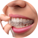 traitement orthodontique aligneurs invisible crée au cabinet d'Aigues-Mortes