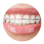 traitement orthodontique discret réalisé au cabinet d'Aigues-Mortes