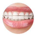 traitement orthodontique discret réalisé au cabinet d'Aigues-Mortes