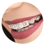 magnifique sourire avec bagues métalliques