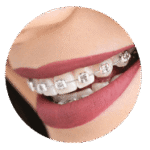 magnifique sourire avec bagues métalliques