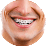 traitement orthodontique pour adulte avec des bagues métalliques