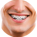 traitement orthodontique pour adulte avec des bagues métalliques