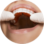 traitement orthodontique sur palais
