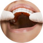 traitement orthodontique sur palais