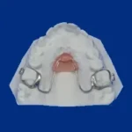 arc lingual en orthodontie à Aigues-Mortes entre Montpellier, Nîmes, Vauvert et Lunel