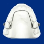 arc lingual pour appareil dentaire enfant, adulte et adolescent à Aigues-Mortes entre Montpellier, Nîmes, Vauvert et Lunel