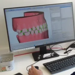 Dentition en 3D dentition en 3D réalisé au cabinet entre Montpellier, Nîmes, Vauvert et Lunel