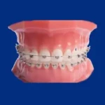 mini bagues pour traitement orthodontique à Aigues-Mortes entre Montpellier, Nîmes, Vauvert et Lunel