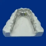 plaque palatine avec vérin pou traitement orthodontique, pose à Aigues-Mortes