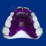 appareil dentaire amovible fabriqué sur place