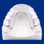 quadhelix pour appareil dentaire