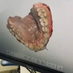 Scan en 3D scan 3d d'une dentition réalisé au cabinet orthodontique d'Aigues-Mortes entre Montpellier, Nîmes et Vauvert